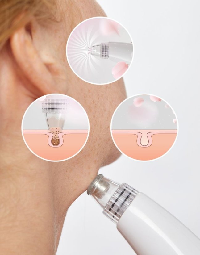 Odstraňovač černých teček Lanaform Limpia